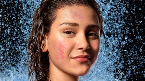 Cold Showers Are Trending As A Remedy For Acne (But Are.